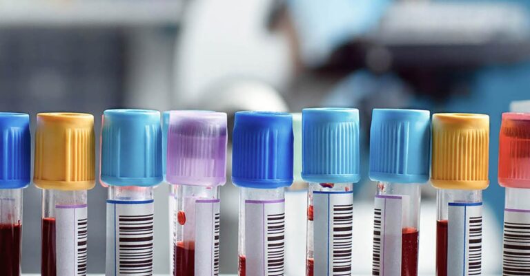 Alzheimerı %91 Doğrulukla Tespit Eden Kan Testi