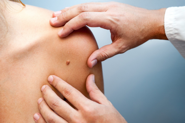 Bilim İnsanları Melanomun “Ölümsüzlük Sırrını” Çözdü