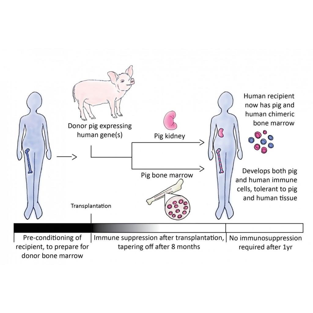 Görsel, genetiği değiştirilmiş domuzdan alınan böbrek ve kemik iliği nakliyle insan bağışıklık sisteminin domuz organlarına uyum sağlamasını amaçlayan bir xenotransplantasyon sürecini gösteriyor.