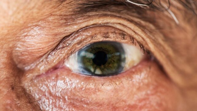 age-related-macular-degeneration-1-642x361